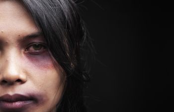 A woman victim of domestic violence with bruised face.